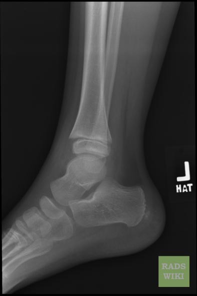 Salter-Harris fracture-II Image courtesy of RadsWiki and copylefted