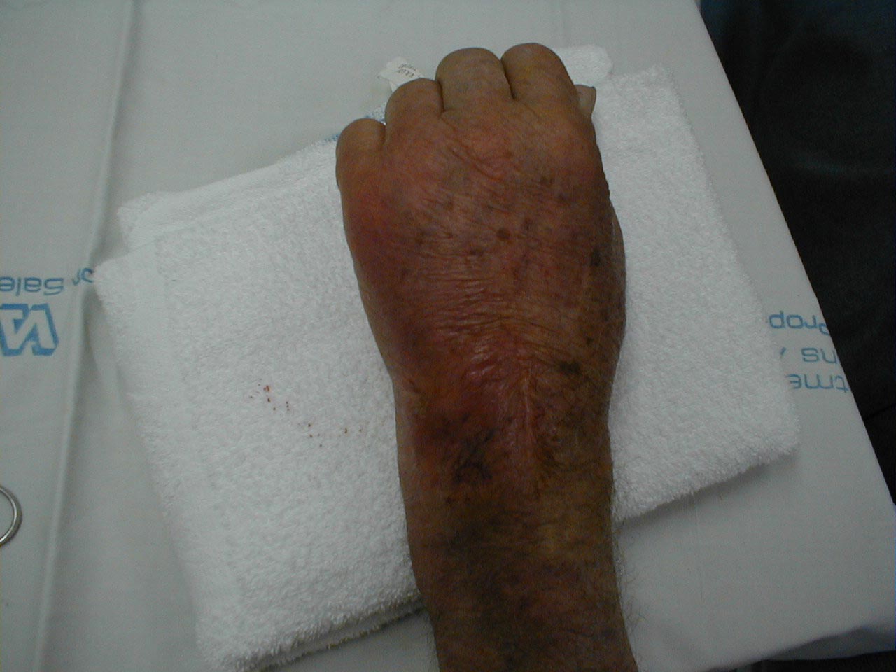 Gout of the Left Wrist: Note swelling and redness over left wrist area.