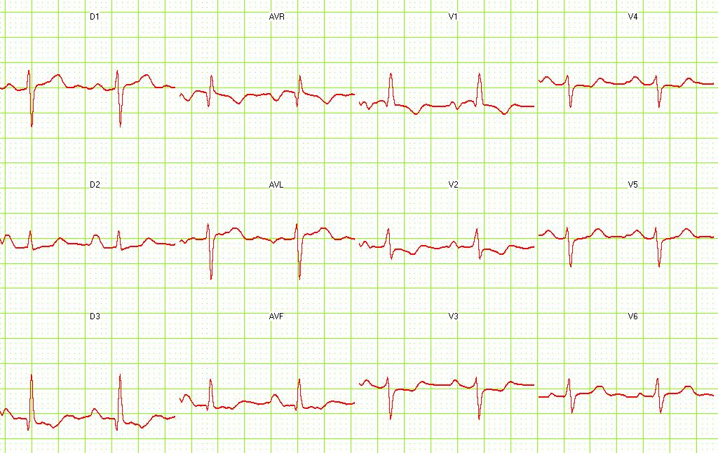 ECG of a patient with pulmonary embolism showing S1-Q3 and signs of right frontal axis deviation.