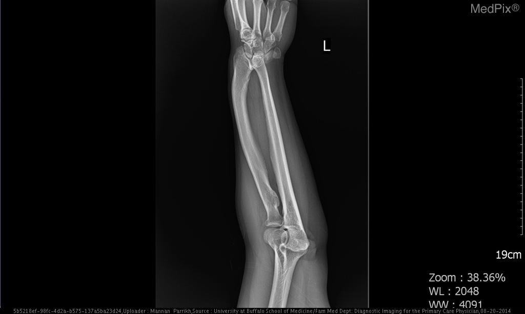 File:Xray Forearm AP Lateral Madelung Deformity.jpg
