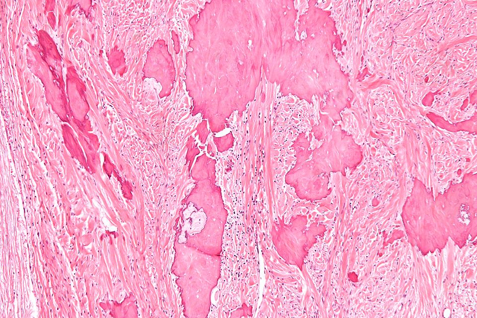 Histopathology specimen of an ovarian fibroma intermediate magnification
