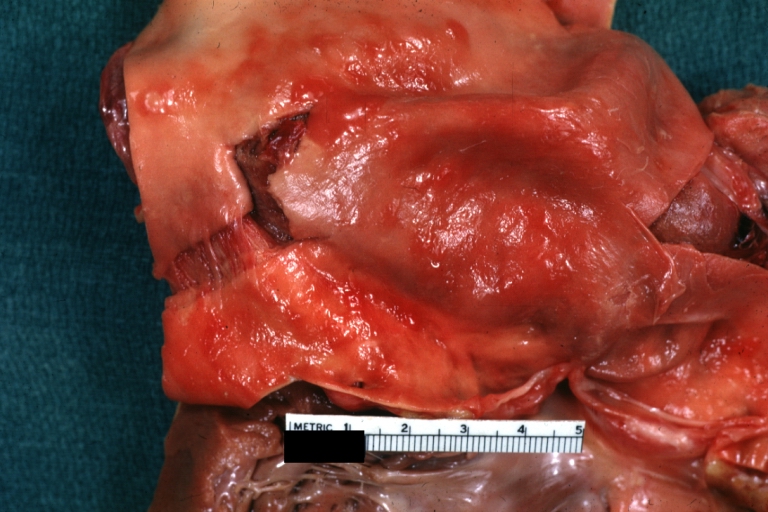 Dissecting Aneurysm: Gross good example angular tear above aortic valve