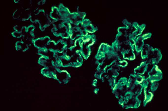 This is an immunofluorescent photomicrograph of granular membranous immunofluorescence (immune complex disease). The antibody used for these studies was specific for IgG.