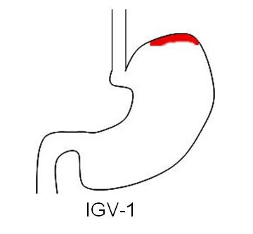 Isolated gastric varices type 1, via Wikipedia.org