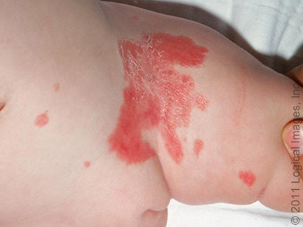 File:Infantile psoriasis.jpg
