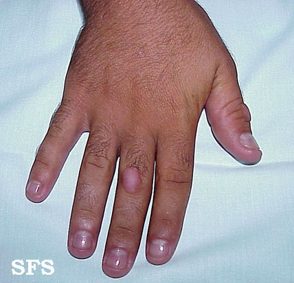 Knuckle Pads. Adapted from Dermatology Atlas.[3]
