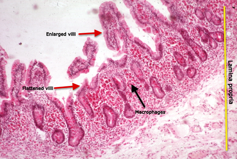 File:Light microscopy of intestine-Whipples Disease.jpg