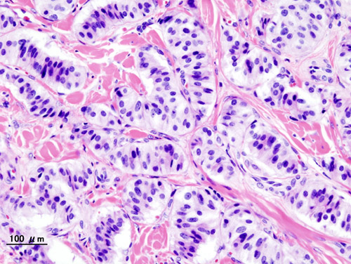 Histopathology of a pancreatic endocrine tumor (insulinoma). Source:https://librepathology.org/wiki/Neuroendocrine_tumour_of_the_pancreas[1]