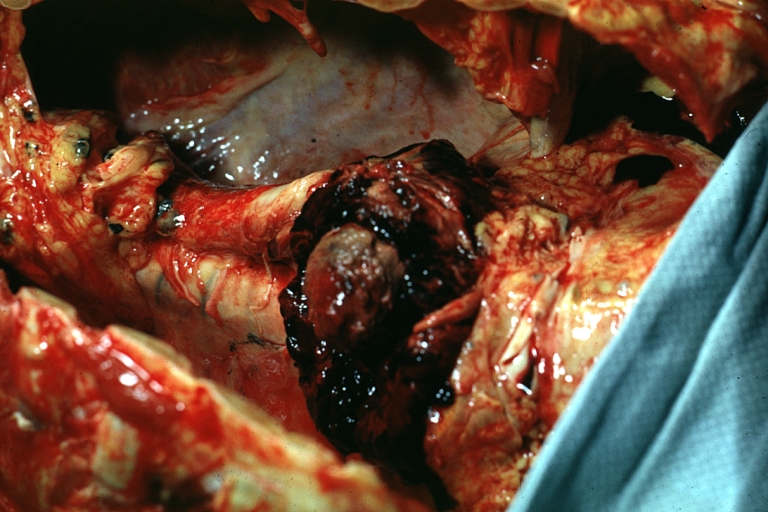Aneurysm: Gross, ruptured thoracic aorta aneurysm, in situ lower thoracic portion (probably due to atherosclerosis)