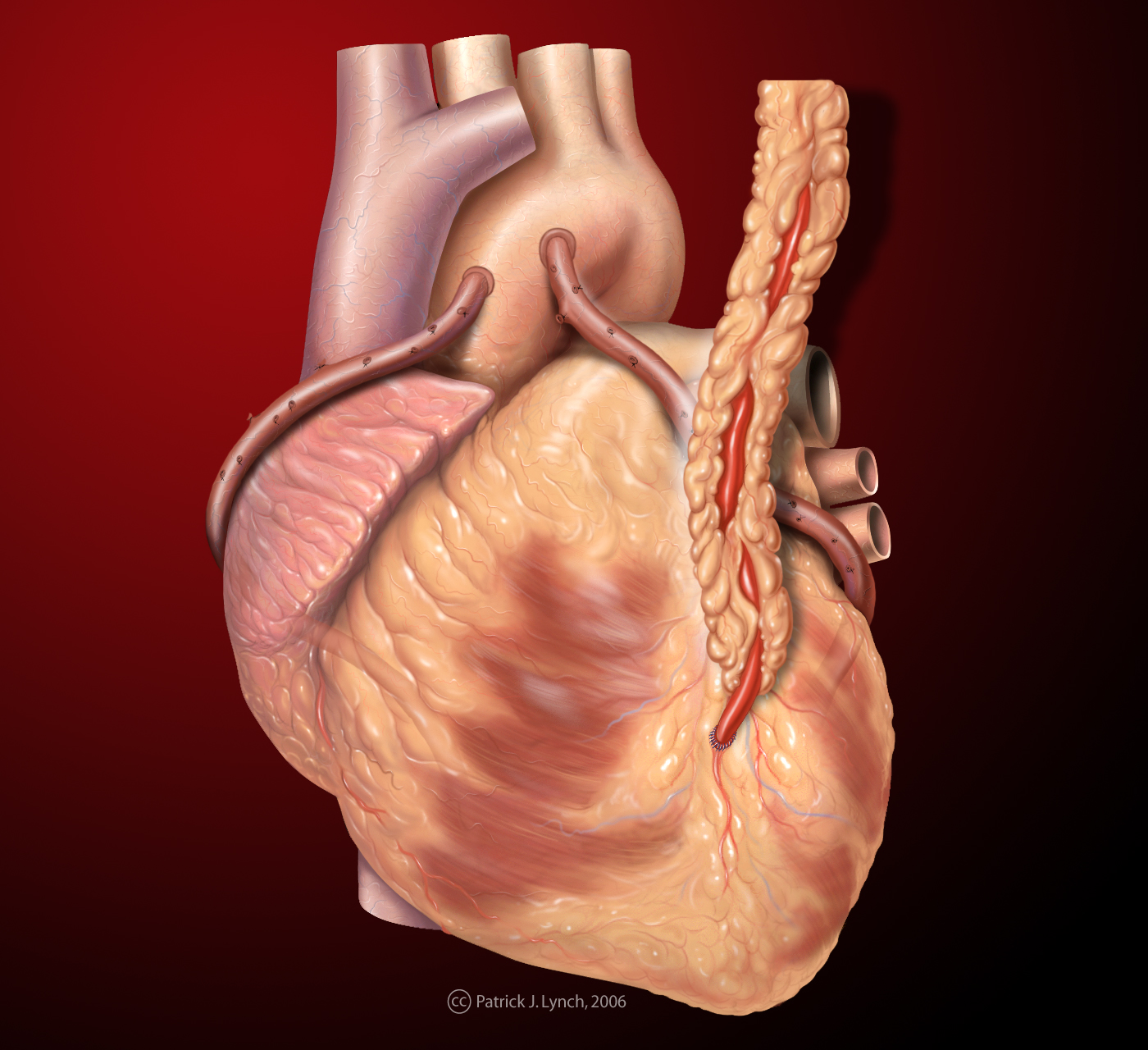 Heart saphenous coronary grafts.jpg