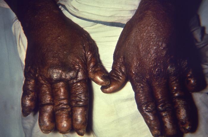 Late stage nodular lepromatous or multibacillary leprosyrds. Note digits of both hands have been eroded over the course of the illness and skin shows numerous cutaneous nodules. Adapted from Public Health Image Library (PHIL), Centers for Disease Control and Prevention.[6]