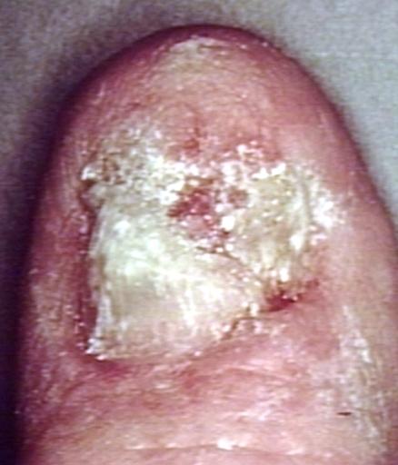 Skin carcinoma.Nail.jpg