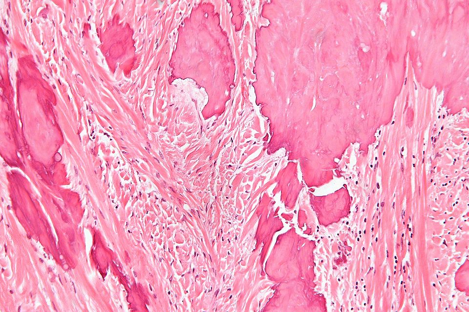 Histopathology specimen of an ovarian fibroma high magnification