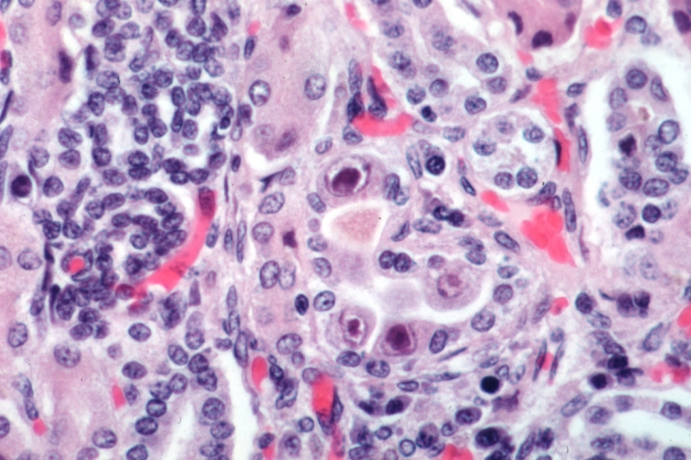 Kidney: Cytomegalic Inclusion Body Disease: Micro high mag H&E. Inclusions are well demonstrated.