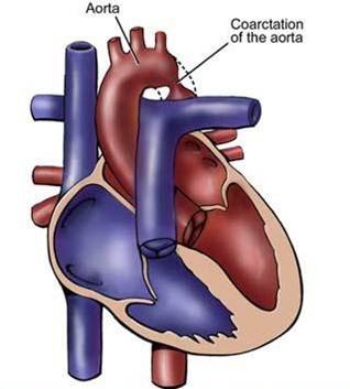 Coarctation of the descending aorta.