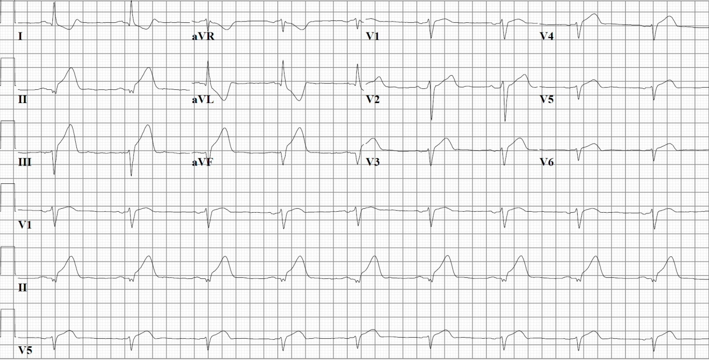 ST elevation at V4R on same patient's EKG (obtained from right precordial leads).