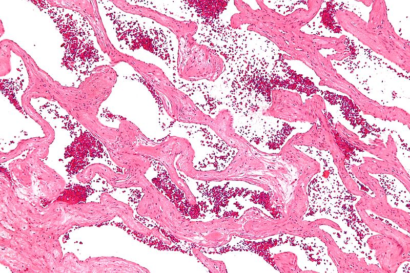 Intermediate magnification micrograph of a cavernous hemangioma of the liver, also hepatic cavernous hemangioma, liver hemangioma,cavernous liver hemangioma. H&E stain. No liver tissue is observed.[4]