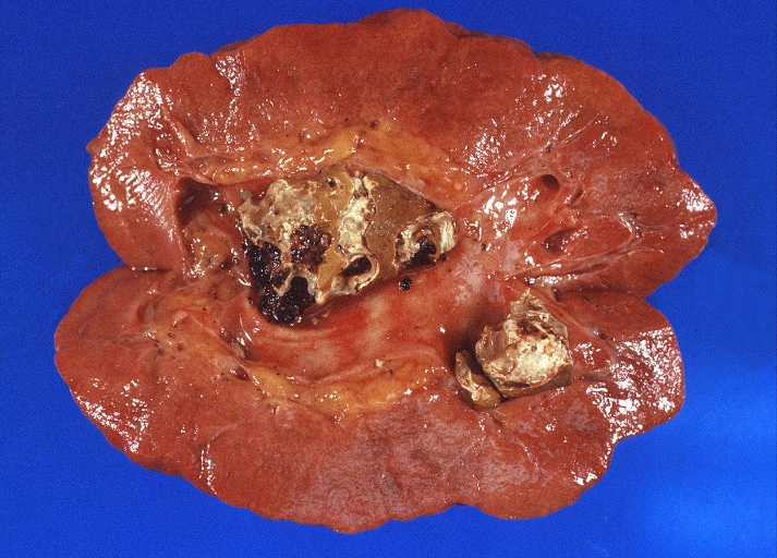 Urinary Tract: Staghorn calculi in renal pelvis, Gout