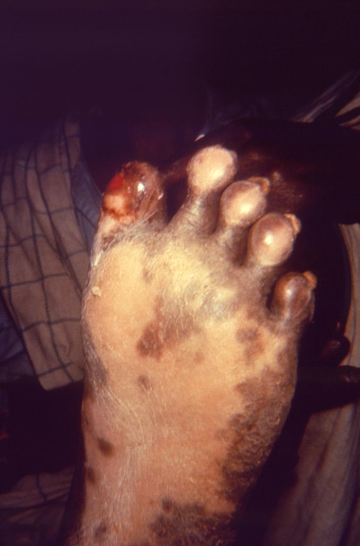 Pathologic changes associated with lepromatous or multibacillary leprosy. Note active ulcerative lesion on the plantar surface of left toe.Adapted from Public Health Image Library (PHIL), Centers for Disease Control and PreventionPublic Health Image Library (PHIL), Centers for Disease Control and Prevention[5]
