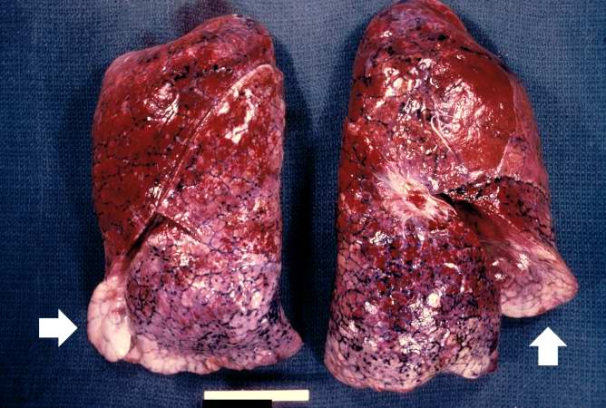 This is a gross photograph of lungs that are distended and red. The reddish coloration of the tissue is due to congestion. Some normal pink lung tissue is seen at the edges of the lungs (arrows).