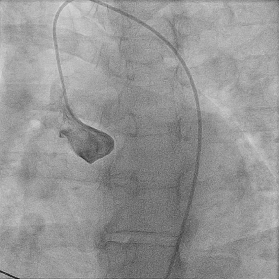 Figure 2. Right anterior oblique cineangiography of non-selective injection of the left coronary sinus
