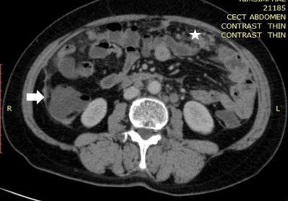 File:CT of peritoneal carcinomatosis with peritoneal thickening and omental deposits.jpg
