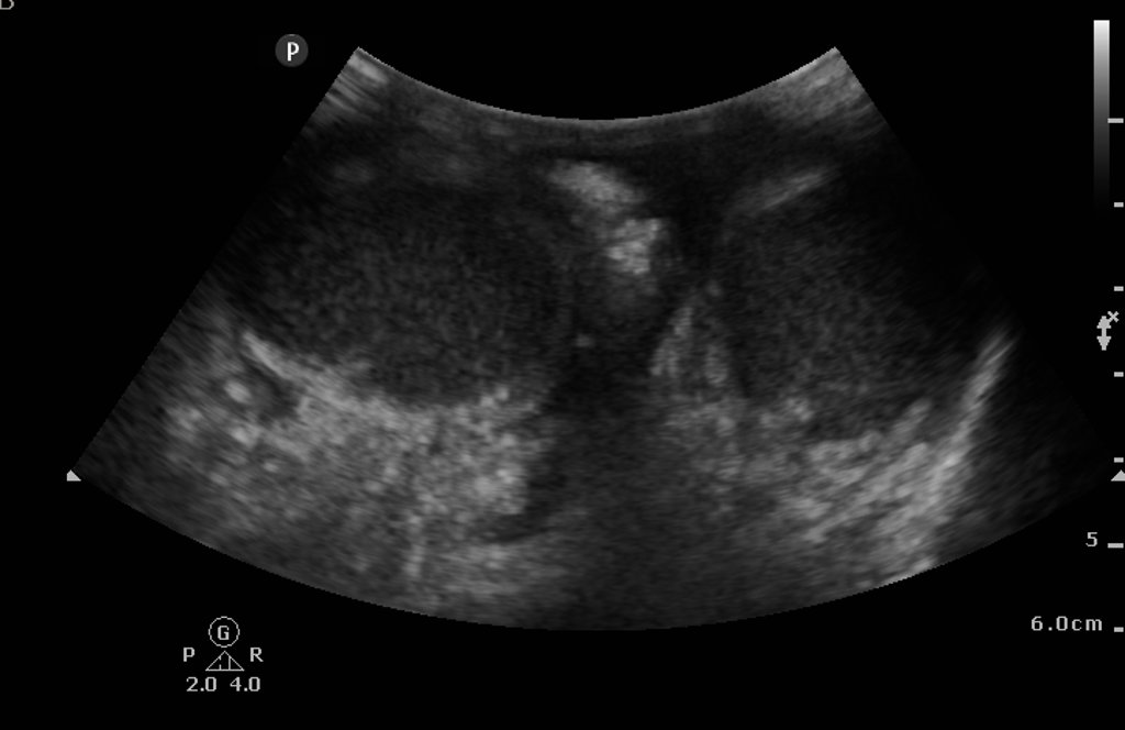 Ultrasound of Fournier's gangrene [19]