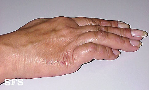 .Neural leprosy Adapted from Dermatology Atlas.[5]