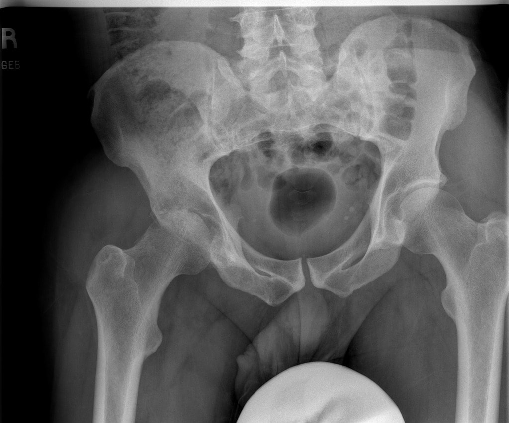 File:Septic arthritis of the hip x-ray.jpg