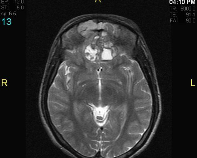 File:T2 esthesioneuroblastoma a.jpg