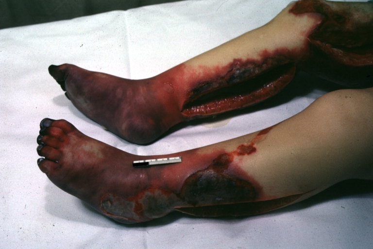 Acrocyanosis: Gross natural color horrible example of gangrene of feet and skin of legs with Pseudomonas sepsis