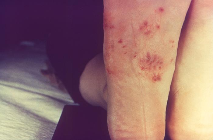 Patient’s right foot displayed a rash that had been diagnosed as tinea pedis, caused by the dermatophytic fungal organism, Trichophyton mentagrophytes. From Public Health Image Library (PHIL). [6]