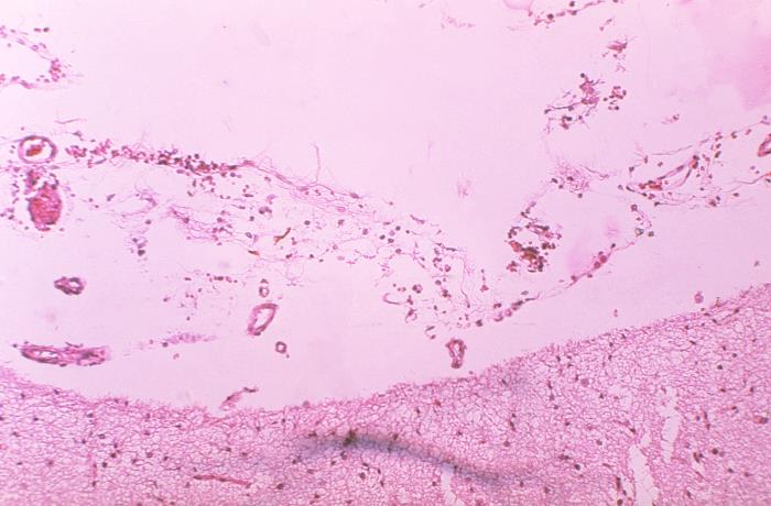 "Hematoxylin-eosin (H&E)-stained photomicrograph of a meningeal tissue sample revealed the presence of histopathologic changes indicative of hemorrhagic meningitis in a case of fatal human anthrax.” Adapted from Public Health Image Library (PHIL), Centers for Disease Control and Prevention.[20]