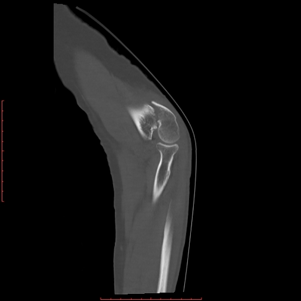File:Displaced-t-condylar-and-supracondylar-fracture-of-the-distal-humerus (4).jpg