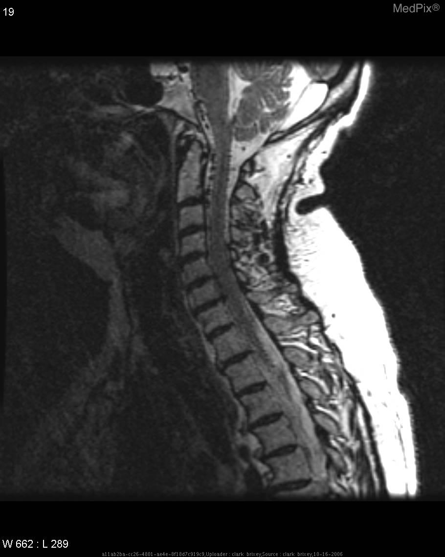File:Dural AVF, cervical spine 1.jpg