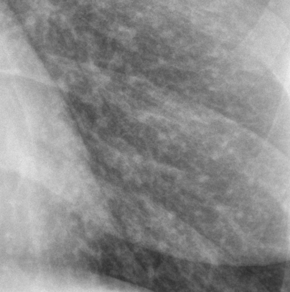Miliary lung nodules consistent with prior and healed varicella pneumonia. [6]