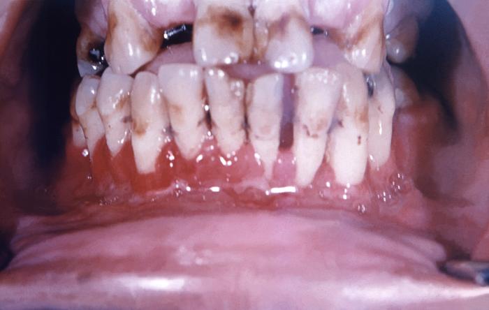 Interior view of an elderly man’s oral cavity. A histoplasmosis infection induced inflammatory response on right inferior gingival tissues. From Public Health Image Library (PHIL). [5]
