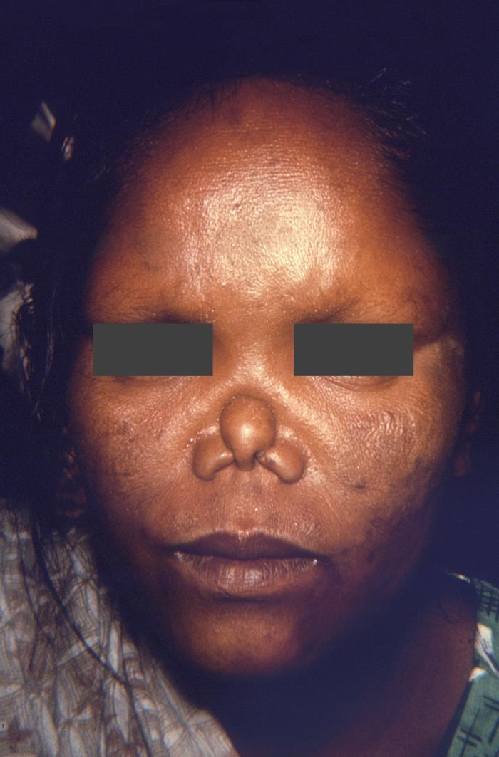 Complications of lepromatous or multibacillary leprosy. Note saddle-nose deformity following disintegration of the nasal cartilage and lack of eyebrows, and mottled coloration of the sclerae bilaterally. Adapted from Public Health Image Library (PHIL), Centers for Disease Control and Prevention.[6]