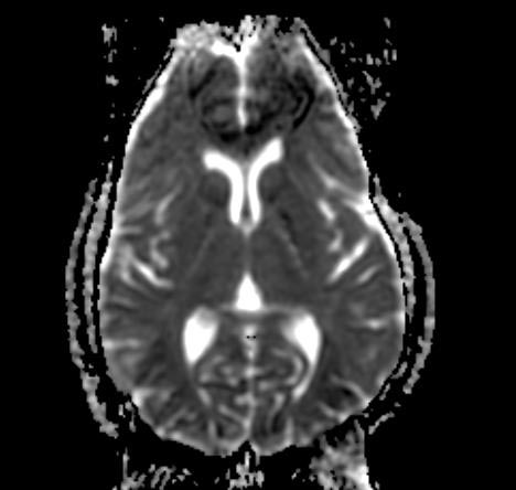 File:Normal-brain-MRI-001.jpg