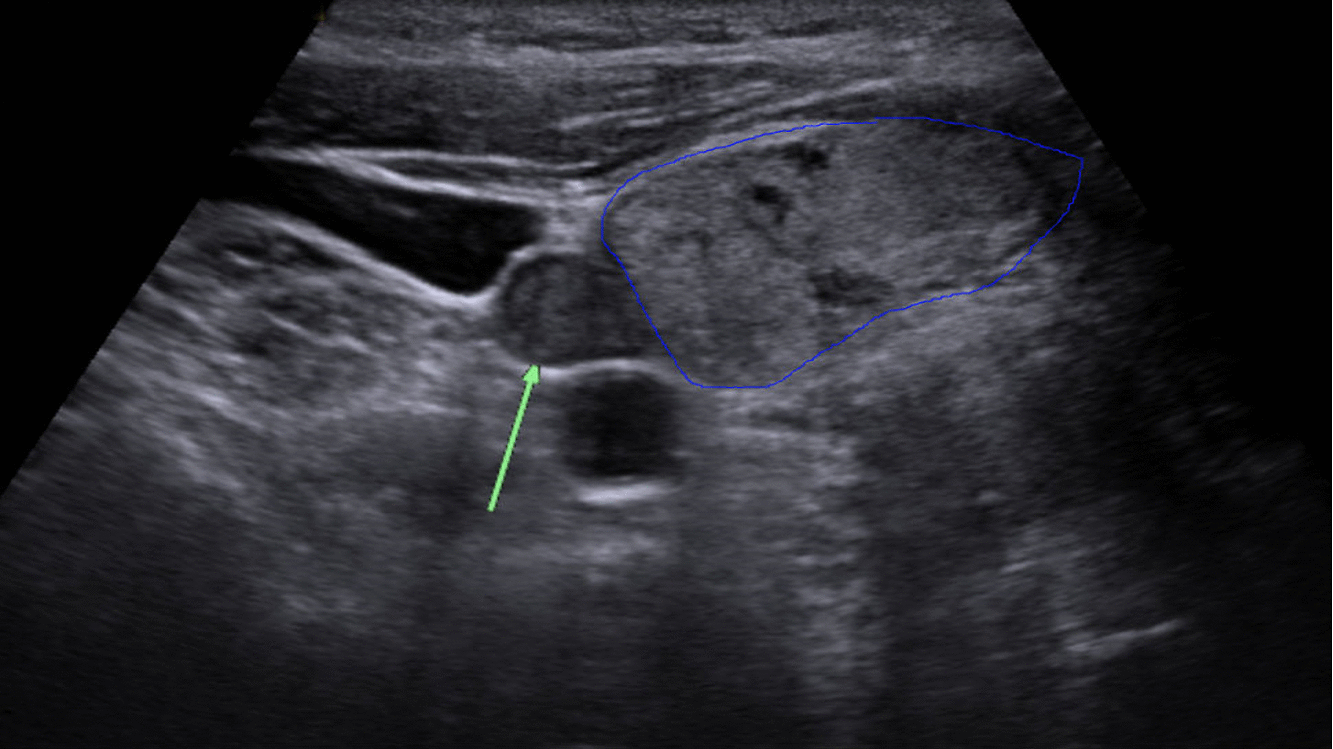 Hyperparathyroidism ultrasound - wikidoc