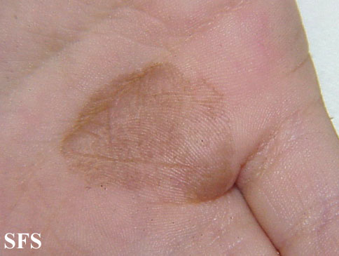 Tinea nigra. Adapted from Dermatology Atlas.[6]