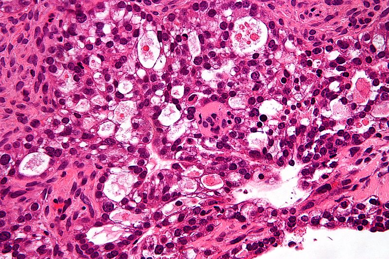 Ovary: Clear cell carcinoma]