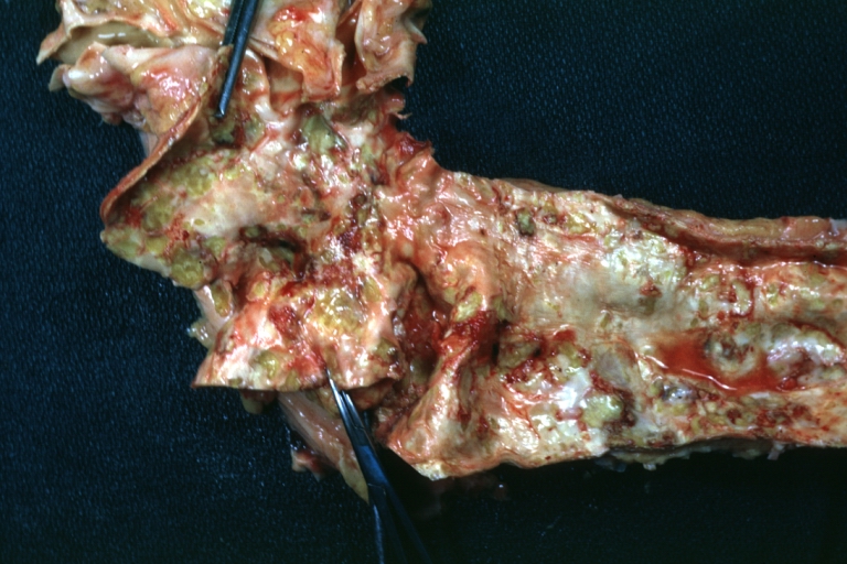 Atherosclerosis: Gross, good example of advanced calcific atherosclerosis in aorta.