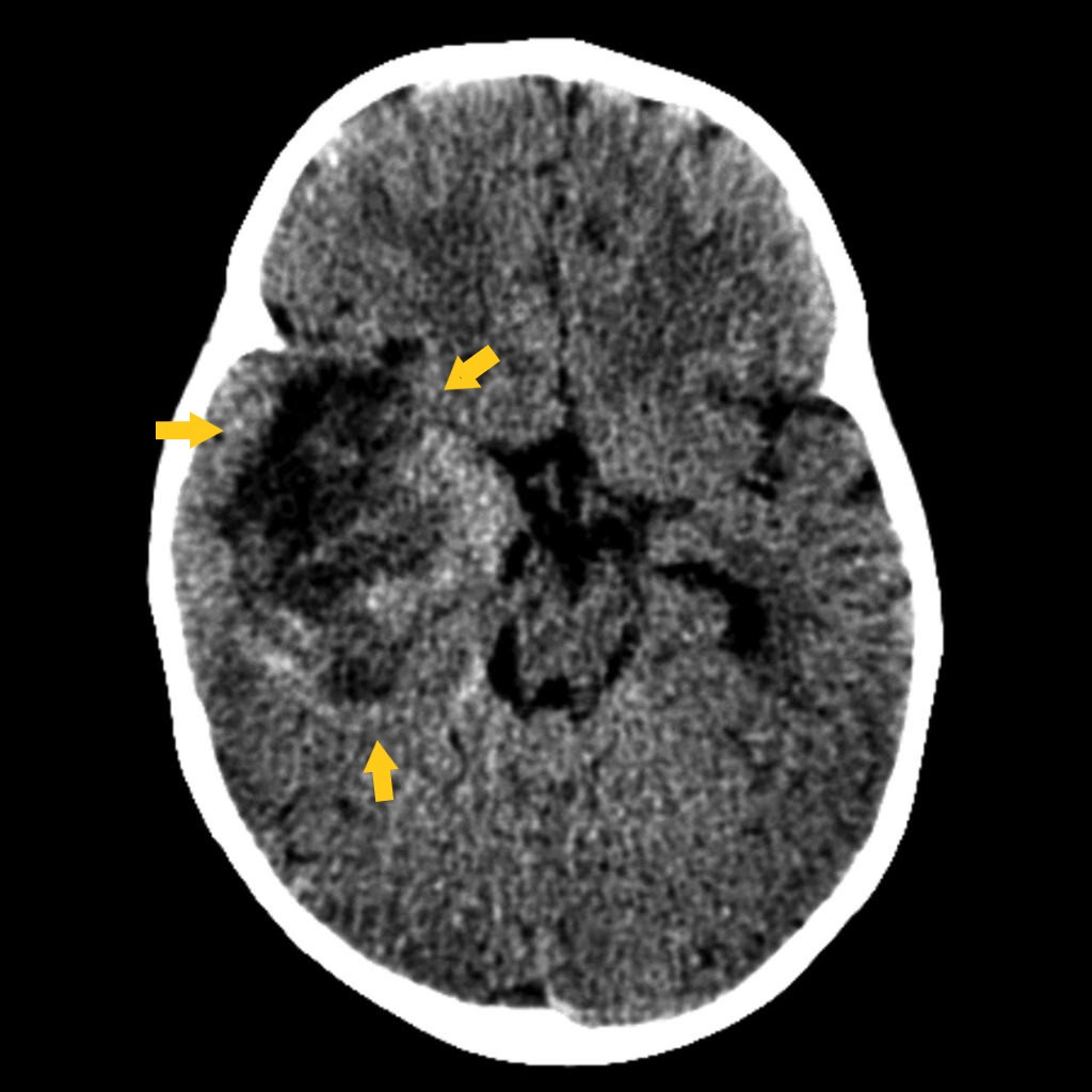 File:Atypical teratoid rhabdoid tumor CT.jpg
