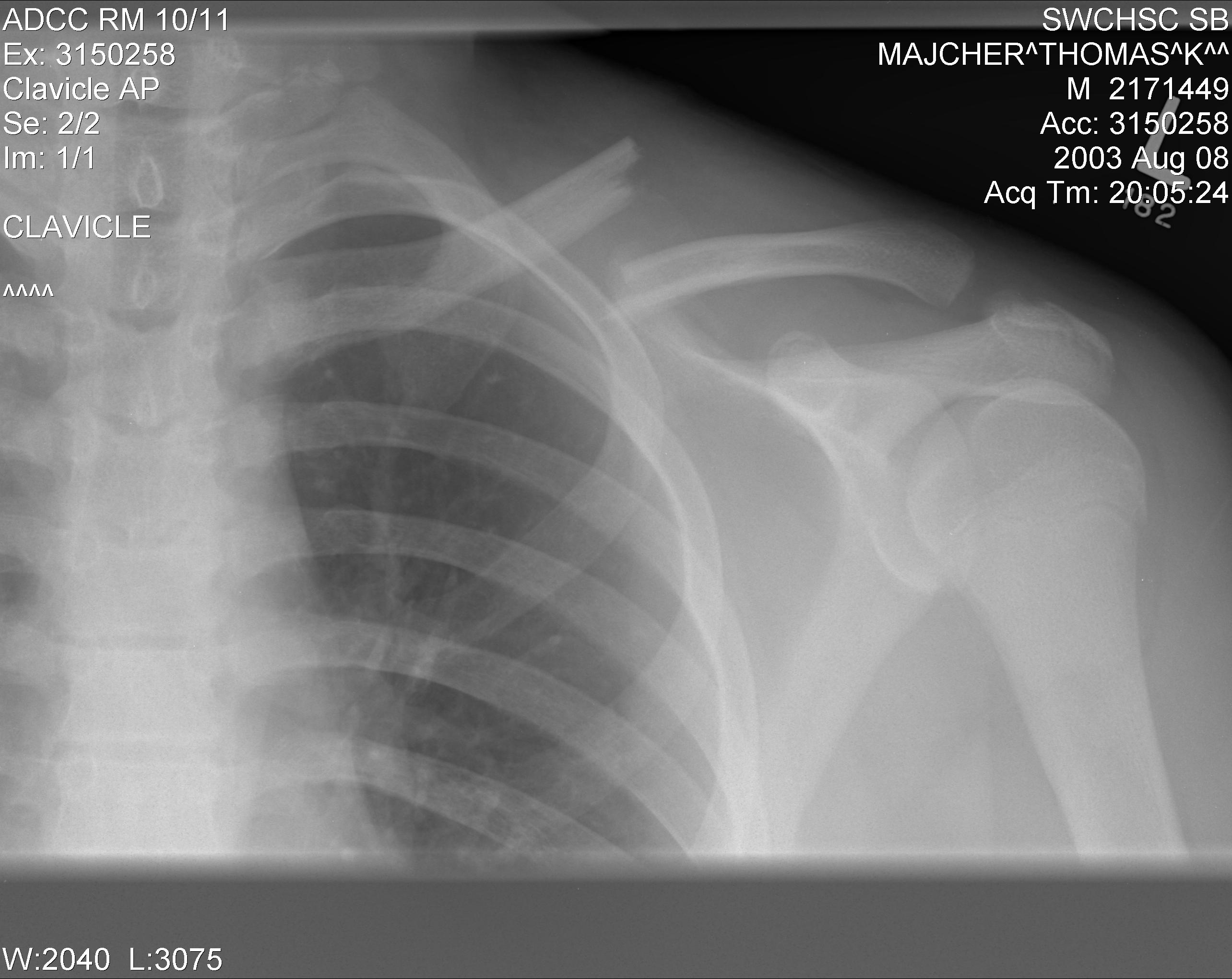 File:Clavicle fracture left.jpg