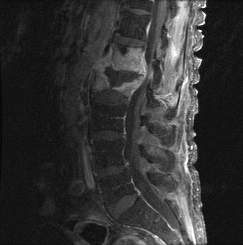 MR image demonstrates lumbar spinal discitis/osteomyelitis