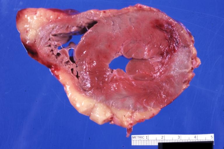 Myocardial Hemorrhage Following Mitral Valve Replacement: Gross, natural color, horizontal section of left ventricle showing a large area of mural hemorrhage extending from anterior papillary muscle