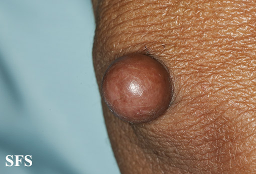Proliferating trichilemmal cyst. With permission from Dermatology Atlas.[3]