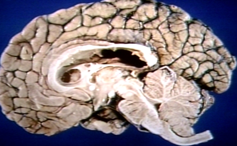 Brain: Arnold Chiari Malformation; Mid Sagittal