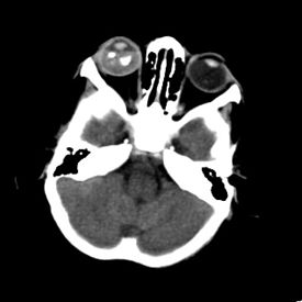 File:Axial non contrast retinoblastoma.jpg